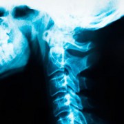 Cervical Myelopathy related image